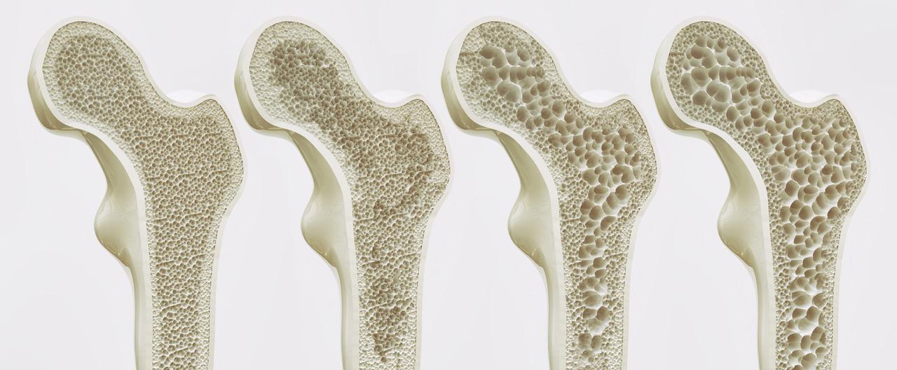 Osteoporóza a jej štádiá.