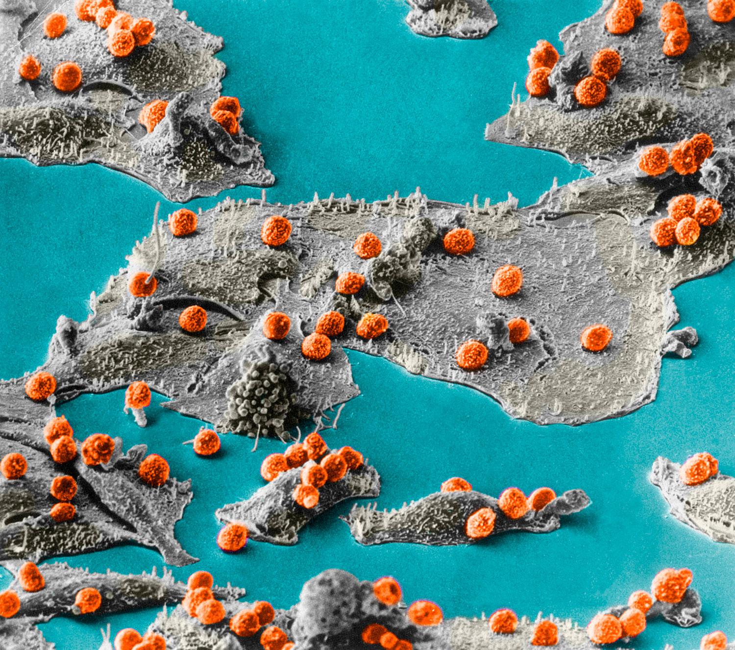 Imunitné bunky (červené) útočia na rakovinové bunky (sivé). Biele krvinky vedia rozpoznať zmenené štruktúry na nádorovej bunke a vedia na ňu zareagovať. V mnohých prípadoch zlikvidujú rakovinu ešte predtým, než sa vyvinie.