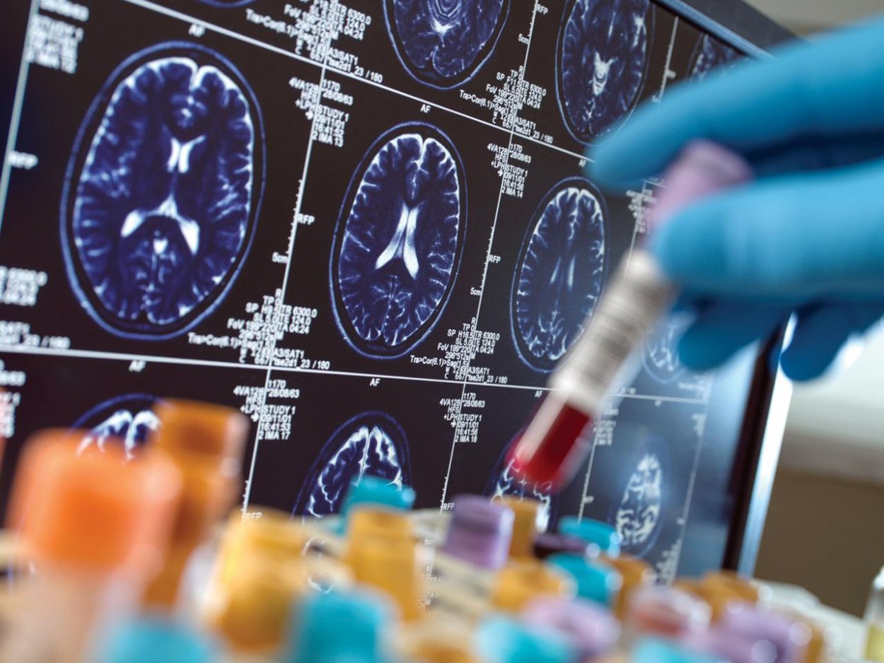 Gargamelizácia klinického výskumu demencie