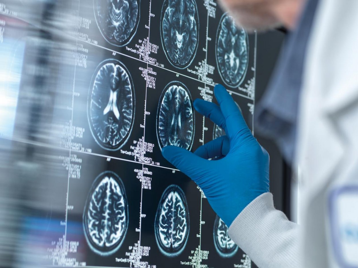 Diagnostika Alzheimerovej choroby zažíva na papieri obrovské pokroky, v praxi je to zložitejšie