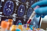 Gargamelizácia klinického výskumu demencie