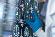 Diagnostika Alzheimerovej choroby zažíva na papieri obrovské pokroky, v praxi je to zložitejšie