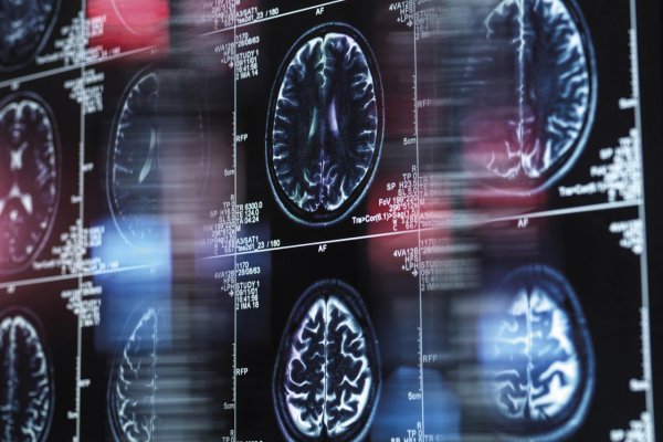 Podvod s Alzheimerom?