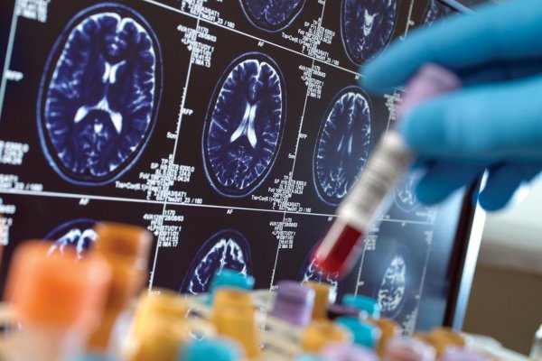 Gargamelizácia klinického výskumu demencie