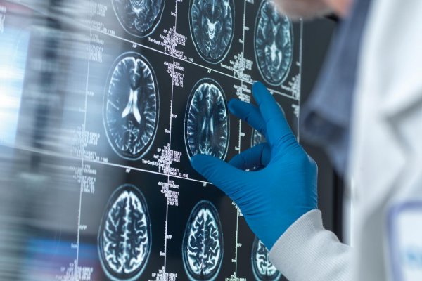 Diagnostika Alzheimerovej choroby zažíva na papieri obrovské pokroky, v praxi je to zložitejšie