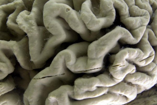 Nový liek môže pomôcť pacientom s Alzheimerom; prináša však aj riziko