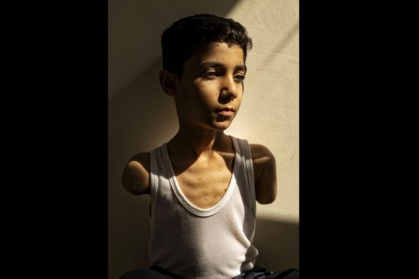 World Press Photo 2025 získala snímka zmrzačeného palestínskeho chlapca